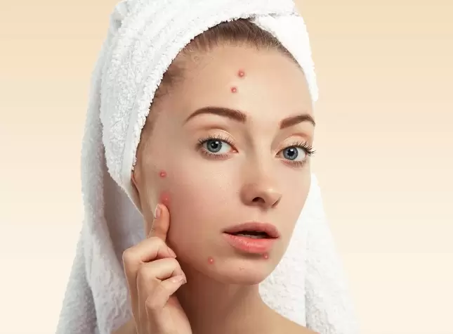 Acne Skin Health Tips